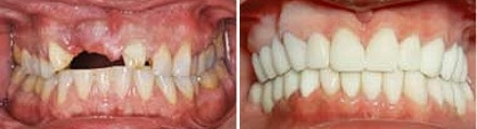 Upper row of teeth before and after gummy smile correction