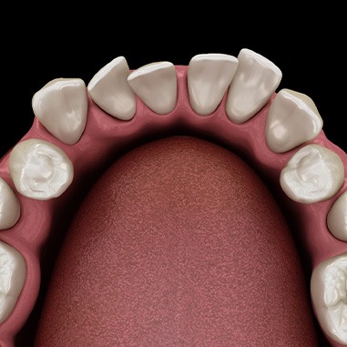 Illustration of gapped teeth