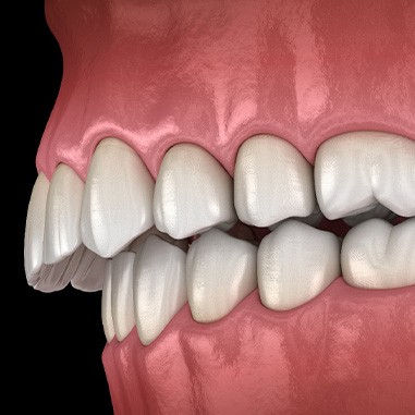 Illustration of an overbite