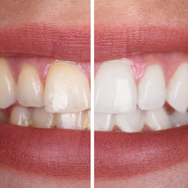 Patient's smile before and after teeth whitening