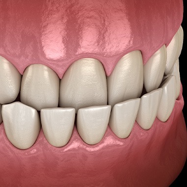 Illustration of an underbite