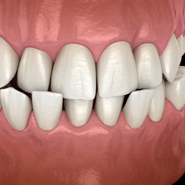 Illustration of a crossbite