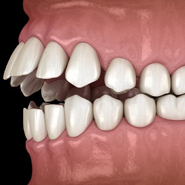 Illustration of an open bite