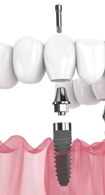 Illustration of All-on-4 dental implants and accompanying denture