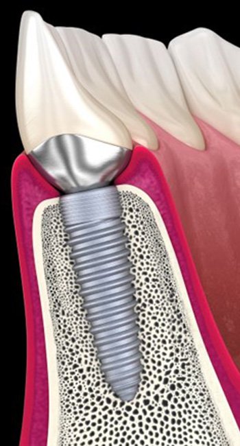 Side-view illustration of traditional dental implant in jawbone
