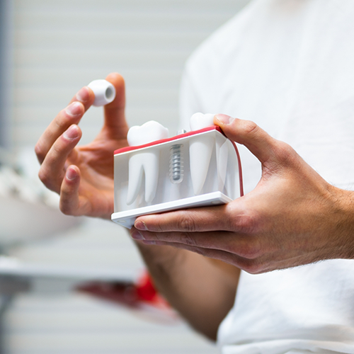 Taking crown off model of dental implant