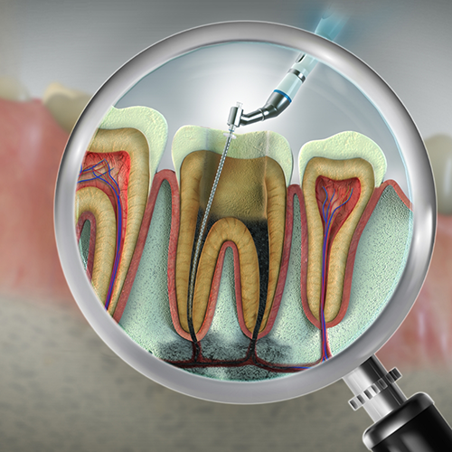 Illustration of magnifying glass showing tooth receiving pulp therapy