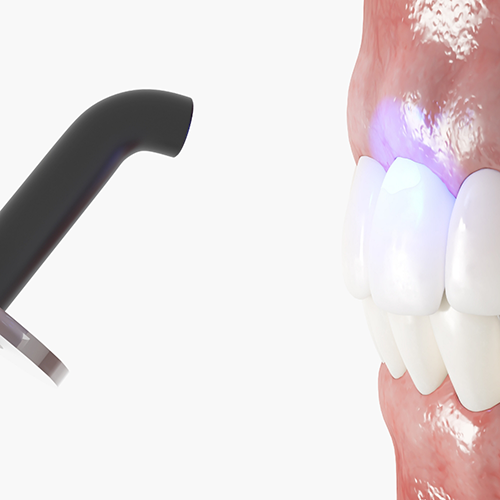 Illustration of direct bonding on upper teeth