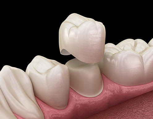 Illustration of a dental crown