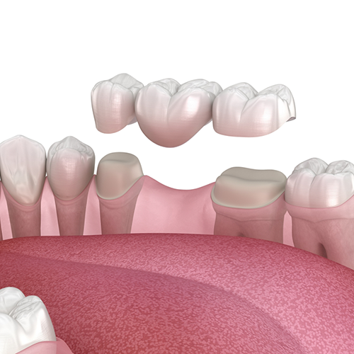 Illustration of dental bridge being attached to teeth in lower arch