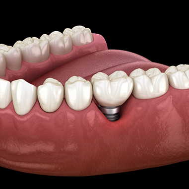 Illustration of single dental implant in lower jaw