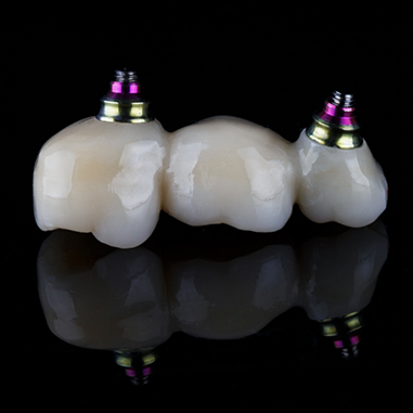 Close up of dental implant bridge