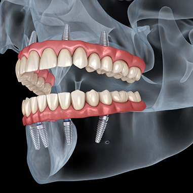 Illustration of implant dentures anchored to jawbone