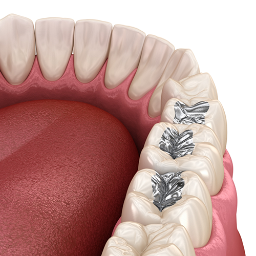 Illustration of teeth in lower arch with dental sealants in Richardson