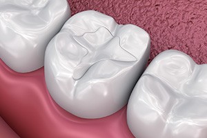 Woman with dark blond hair having fillings cured with ultraviolet curing light