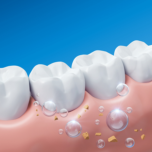 Illustration of teeth after fluoride treatment in Richardson