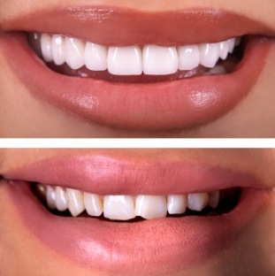 Smile before and after chipped and discolored teeth treated by Richardson dentist