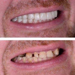 Close up of man smiling before and after treatment for missing and stained teeth