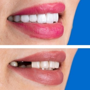 Close up of smile before and after replacing missing tooth