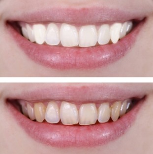 Smile before and after teeth whitening