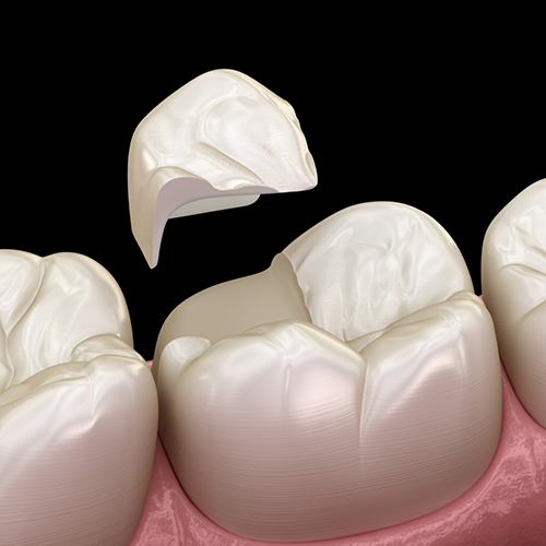 Illustration of dental onlay in Richardson being placed on tooth