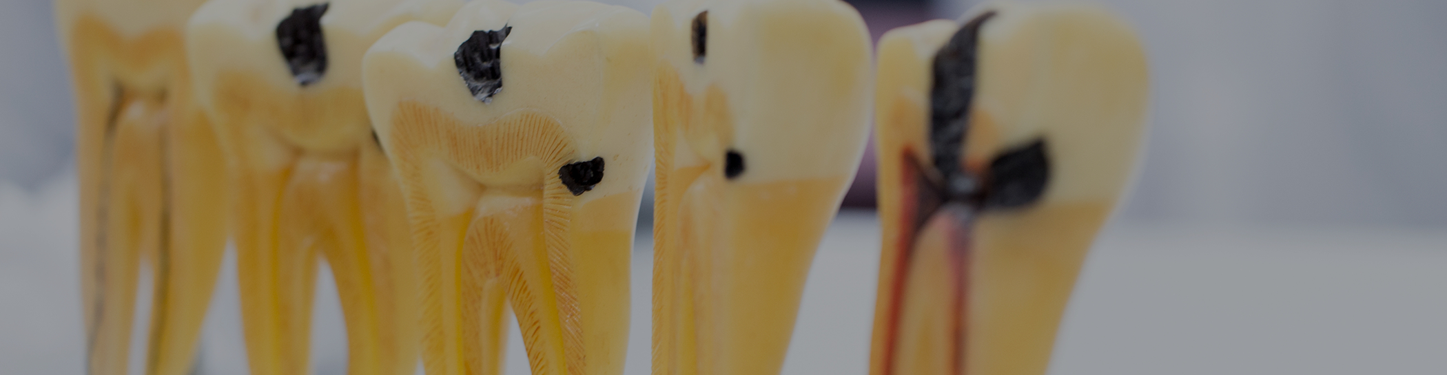Model of decayed teeth in plastic tray