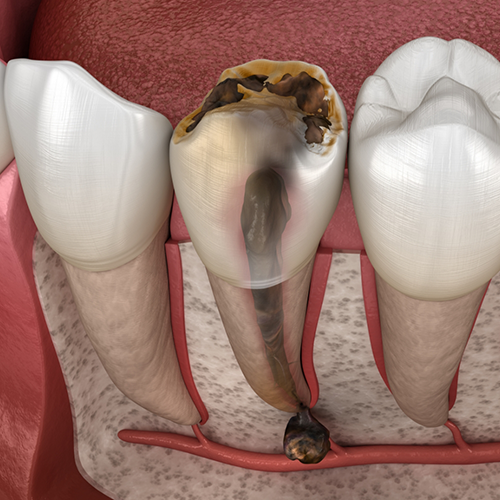 Illustration of a badly decayed and infected tooth