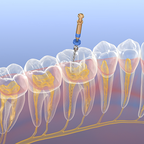 Illustration of root canal treatment in Richardson