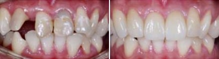 Close up of smile before and after straightening teeth and replacing a missing tooth