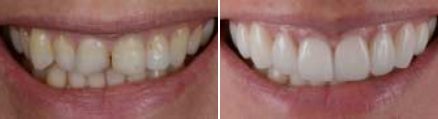 Smiling man before and after replacing a missing upper tooth