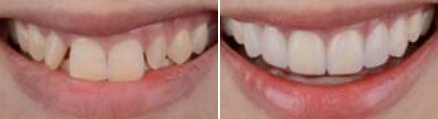 Smile before and after correcting discolored and misaligned teeth