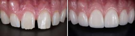 Close up of smile before and after straightening teeth and replacing a missing tooth