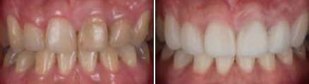 Upper row of teeth before and after fixing slightly gapped teeth