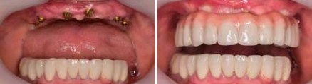 Close up of teeth before and after teeth whitening