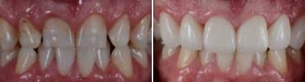 Close up of mouth before and after replacing full arch of upper teeth