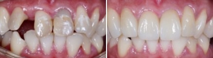 Close up of smile before and after straightening teeth and replacing a missing tooth