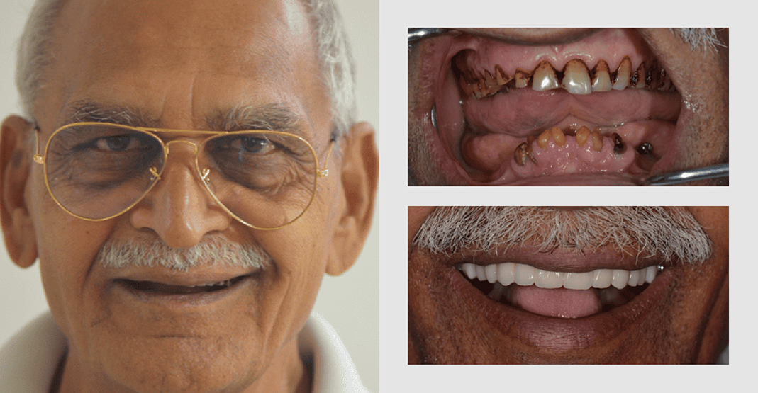Before and after pictures of older man with glasses