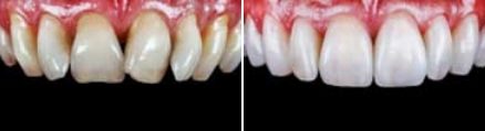 Smile before and after fixing stained teeth