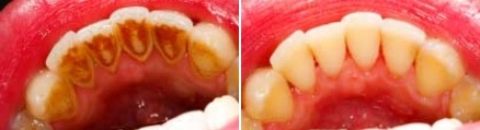 Upper row of teeth before and after straightening and whitening