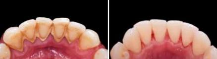 Digital rendering of teeth before and after treatment with braces