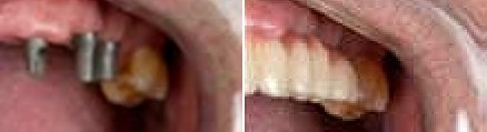 Close up of smile before and after fixing stained and crooked teeth