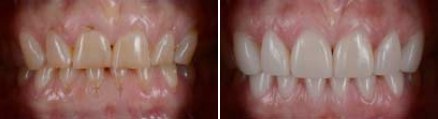 Aerial view of teeth before and after correcting dark spots