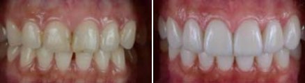 Mouth before and after restoring dental implants