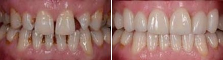 Mouth before and after treating tooth discoloration