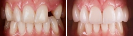 Close up of mouth before and after replacing a missing upper tooth