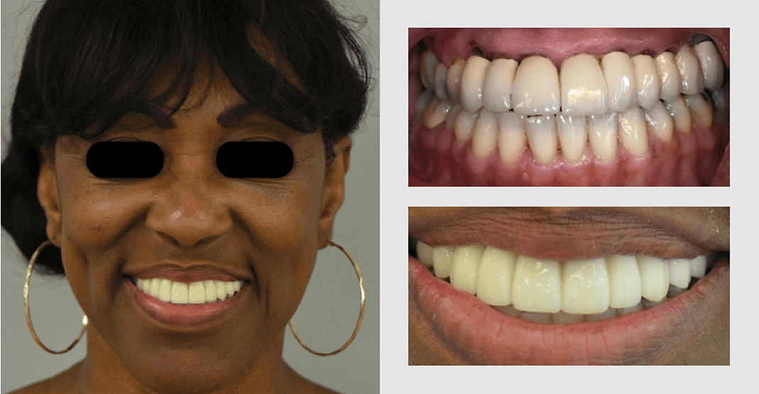 Before and after pictures of woman with large hoop earrings