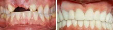 Mouth before and after teeth whitening