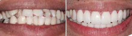 Mouth before and after correcting gray spots and small gaps between teeth