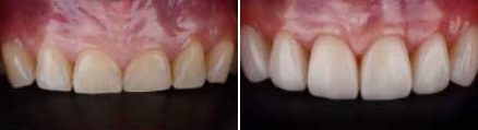 Mouth before and after teeth whitening and replacing a few missing teeth