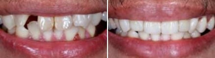 Smile before and after orthodontic treatment